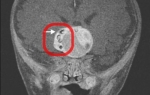 Tumor na mozgu