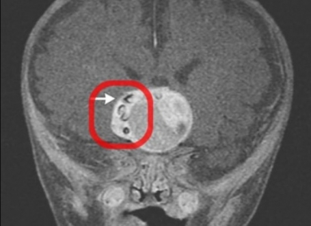 Tumor na mozgu