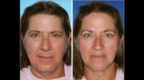 Foto: American society of plastic surgeons