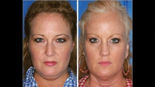 Foto: American society of plastic surgeons