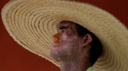 Oboljenje kože Foto: AP