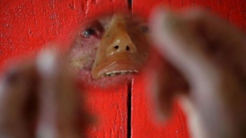 Oboljenje kože Foto: AP