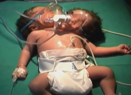 Beba sa dve glave / Printskrin:YouTube/ USWorldNews